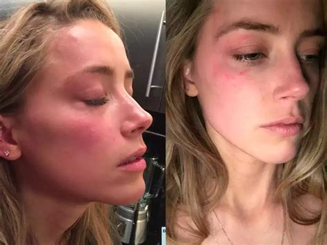 Amber Heards Lawyers Share Photos Of The Actress With Red Bruises On Her Face Allegedly