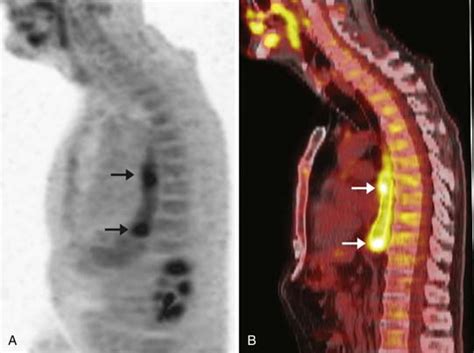 Esophageal Cancer Radiology Key