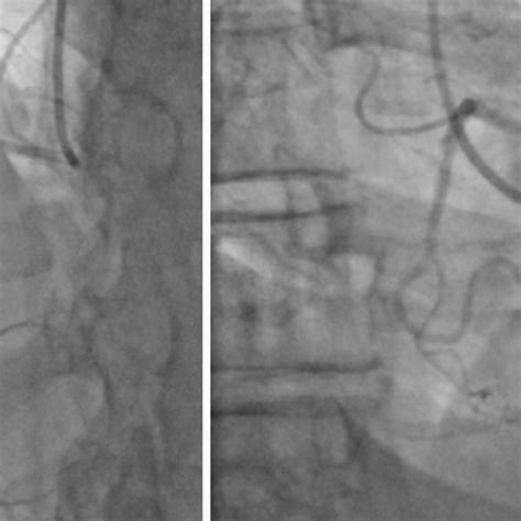 On The Left Rca Angiogram Left Anterior Oblique Projection With
