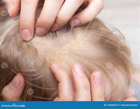 Fungal Skin Disease Seborrheic Dermatitis In A Child`s Head Close Up
