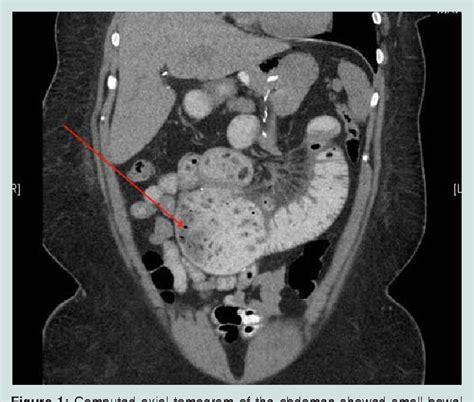 Figure 1 From Small Intestinal Bezoar After Gastric Bypass An Unusual