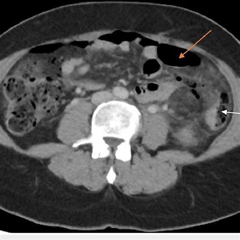 Ct Abdomen Pelvis Axial Cut Showing Luq Abdominal Abscess With