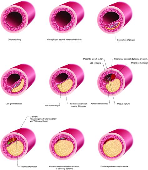 Coronary Artery Disease Pathophysiology Pdf Nursing Pelajaran