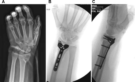 Wrist Fractures And Osteoporosis Orthopedic Clinics