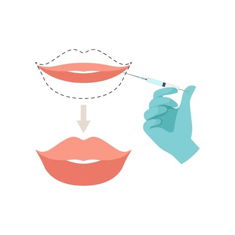 Premium Vector Lips Augmentation Procedure Hyaluronic Acid Lip