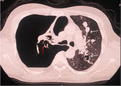 Hrct Thorax Axial Image Showing Central Bronchiectasis With Finger In