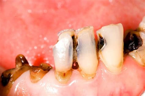 Tooth Caries Stock Photo Image Of Periodontal Decay 28859026