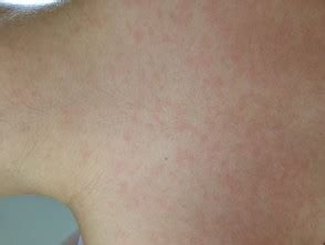 An amoxicillin rash is usually found therefore, use of amoxicillin drug may cause the rash. Infectious mononucleosis | DermNet NZ