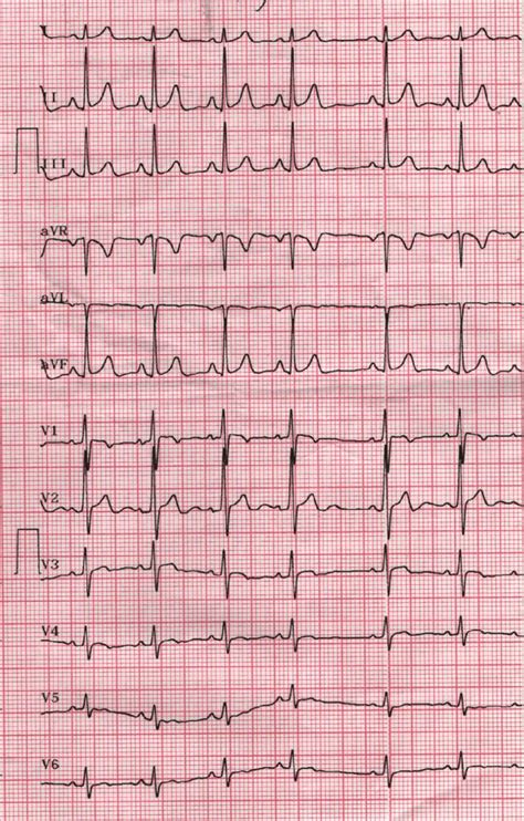 Ecg Showing Rs Complexes In The Right Sided Leads V 1 V 3 And Qrs