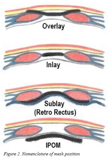 Hig Sa Guidelines For The Management Of Ventral Hernias