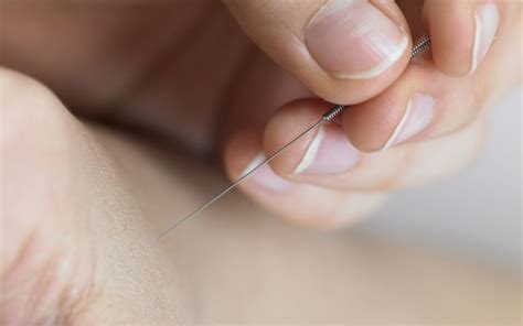 Acupuncturists Vs Medical Doctors Practicing Acupuncture Vs Physical