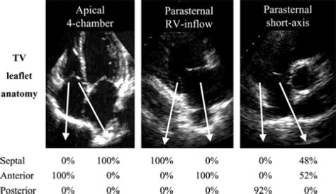 Identification Of The Tricuspid Valve Leaflets Seen On Open I