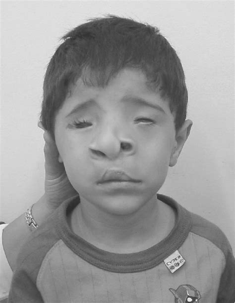 Case 1 At Age 6 Years Note Typical Facial Phenotype Download