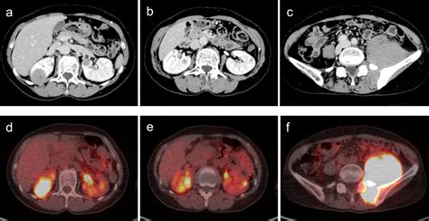 Diffuse Large B Cell Lymphoma With Involvement Of The Kidney Bmj Case