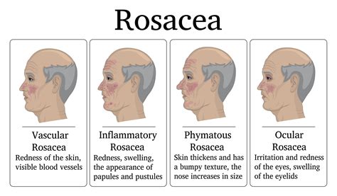 Dealing With Rosacea Charleston Dermatology