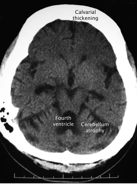Cerebral Atrophy And Skull Thickening Due To Chronic Phenytoin Therapy