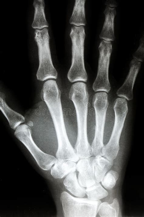 X Ray Of The Right Hand Stock Photo Image Of Radiological 53096640