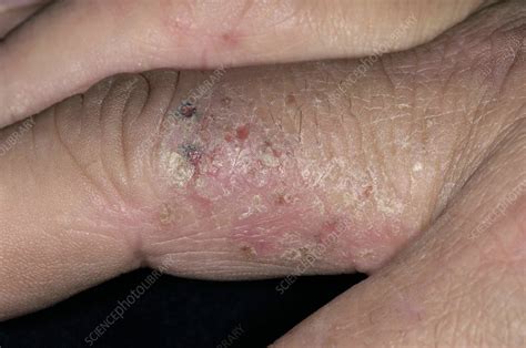 Contact Dermatitis On The Fingers Stock Image C0042411 Science