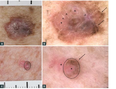 Racgp Diagnosis And Management Of Cutaneous Melanoma