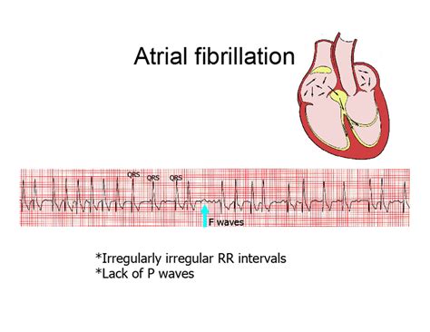 Atrial Fibrillation Interactive Health