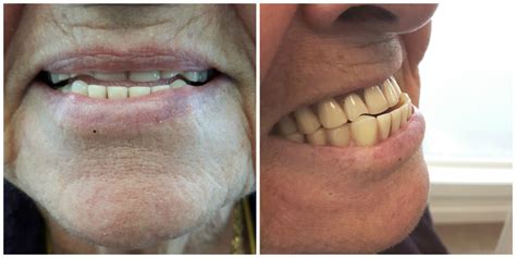 Complete Upper And Lower Dentures Kelowna Denture Clinic