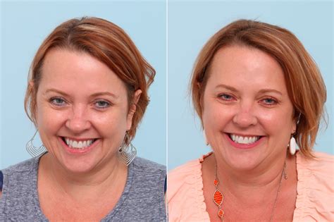 Botox Cosmetic And Xeomin Photos Houston Tx Patient 7767