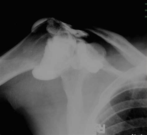 Rotator Cuff Tear On Shoulder Arthrogram X Rays Case Studies Ctisus