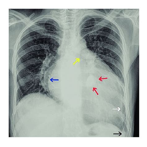 Chest Radiography Posteroanterior View Enlarged Heart Next To The