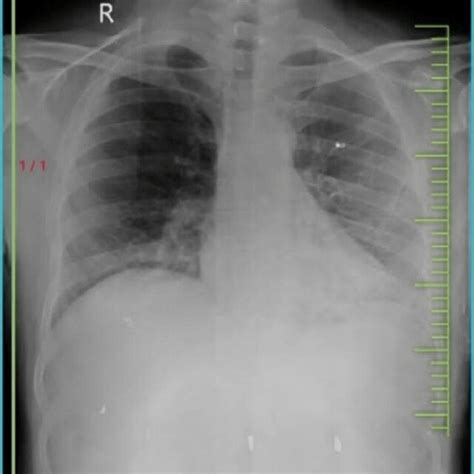 X Ray Showing A Mass In The Right Supraclavicular Region With No Bony