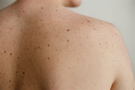 When To Worry About A Mole And See A Dermatologist