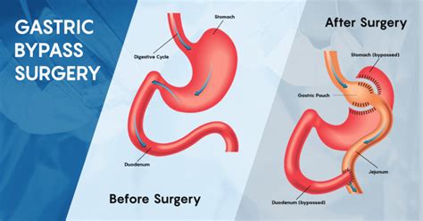 Gastric Bypass Surgery Is It As Good As They Say What To Expect One
