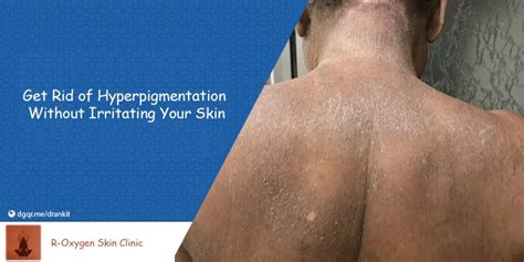 Hyperpigmentation Causes Symptoms Treatments And More