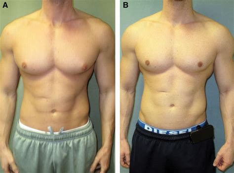 Anatomy Of The Gynecomastia Tissue And Its Clinical Significance