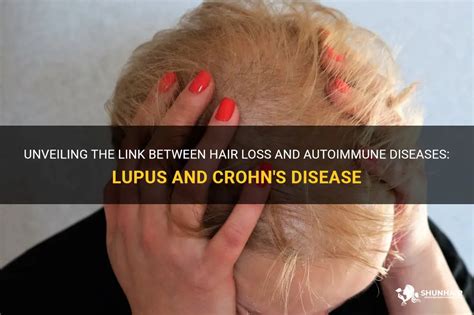 Unveiling The Link Between Hair Loss And Autoimmune Diseases Lupus And