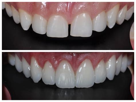 Qual A Diferença Entre Lente De Contato Dental E Faceta Em Porcelana