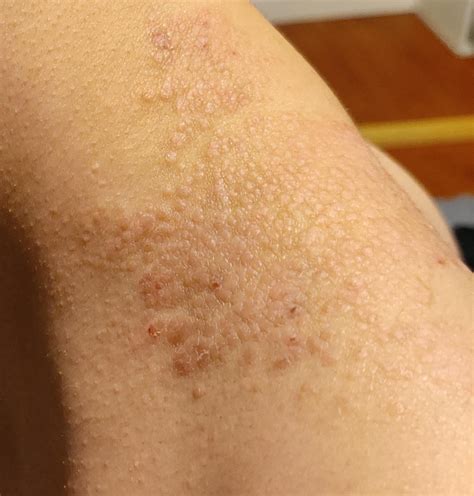 Rash On Neck And Below Belly Button Psoriasis Rdermatology