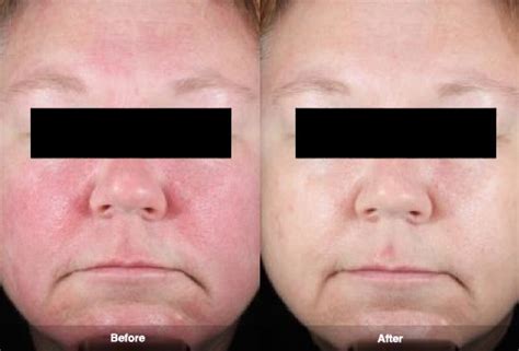 Laser Treatment For Rosacea Richmond Hill Cosmetic Clinic