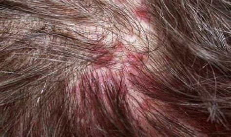 How To Get Rid Of Red Spots On Scalp