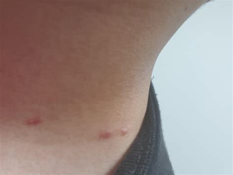 3 Weird Bumps On My Neck Its Been Here For More Than A Few Weeks And Still Havent Gotten