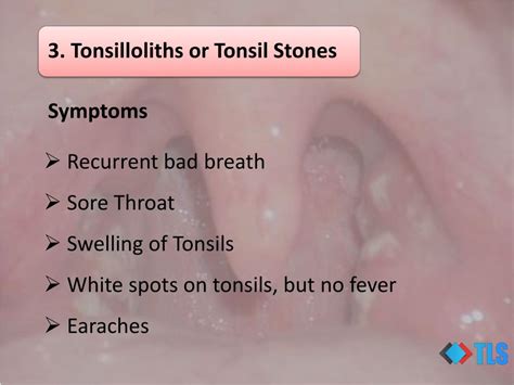 Ppt 8 Causes Of White Spots On Tonsils You May Not Know Powerpoint