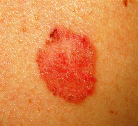 Red Patch On Leg Skin Cancer Cancerwalls