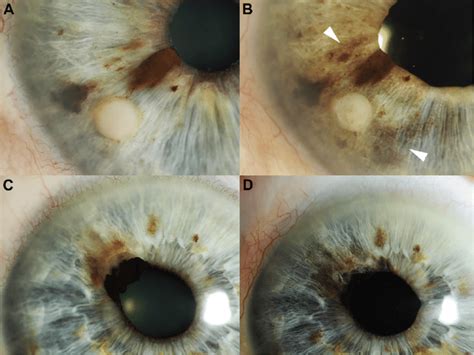Slit Lamp Photographs Of An Amelanotic Iris Melanoma A Before Surgery