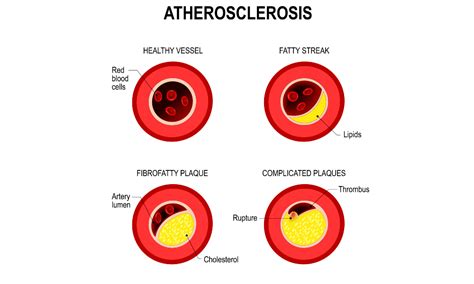 Atherosclerosis A Hard Problem To Treat Vascular Surgery
