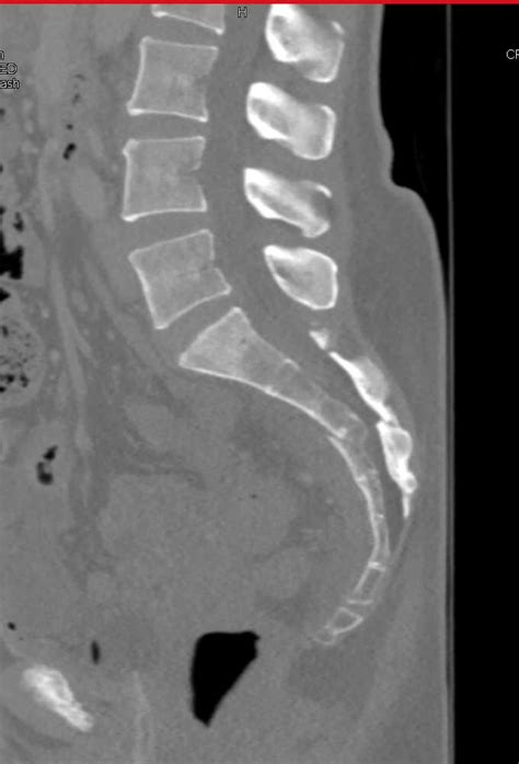 3d Of A Sacral Fracture Trauma Case Studies Ctisus Ct Scanning