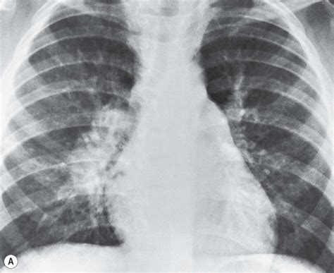 Radiology Pearls Tuberculosis