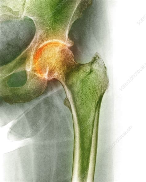 Arthritis Of The Hip X Ray Stock Image F0033629 Science Photo