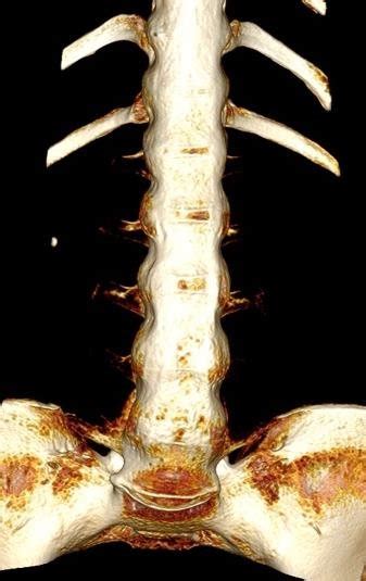 Vrt View Showing The Bamboo Spine Appearance Download Scientific