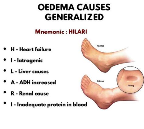 Generalized Edema Medizzy