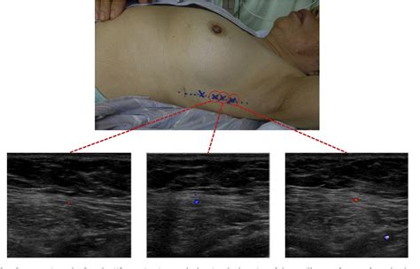 Figure 2 From Preoperative Color Doppler Ultrasonographic Examination