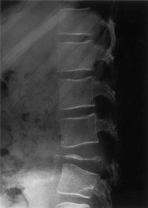 From this precise slide and to the end of it, pretty. Lateral lumbar spine in a child, showing a vertebra plana ...